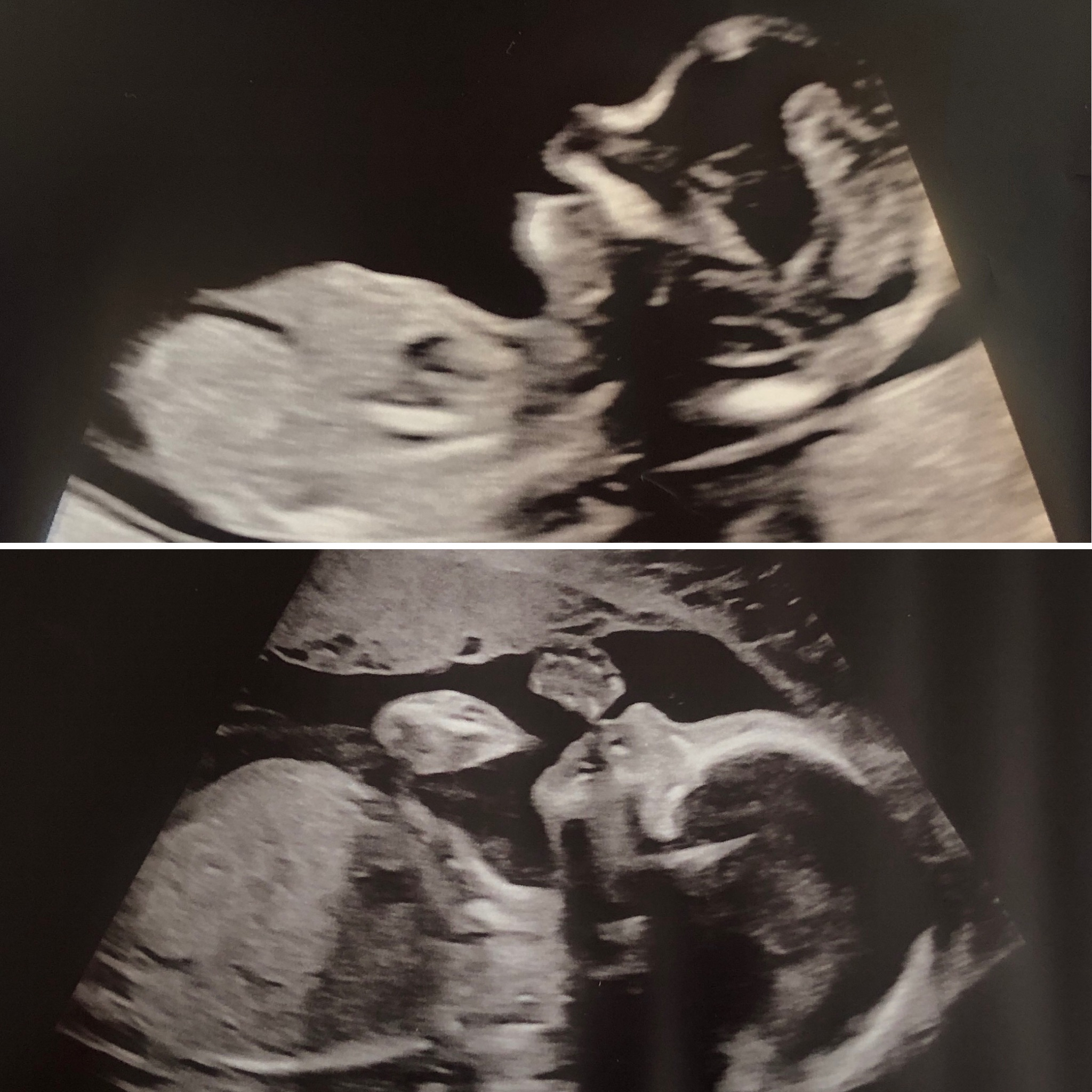 Ultrasound